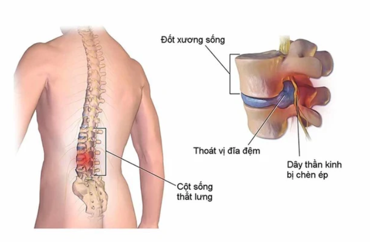 đau thắt lưng đau thắt lưng